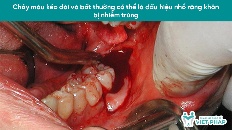 Vết nhổ răng khôn chảy máu kéo dài, lẫn mủ là dấu hiệu nhiễm trùng