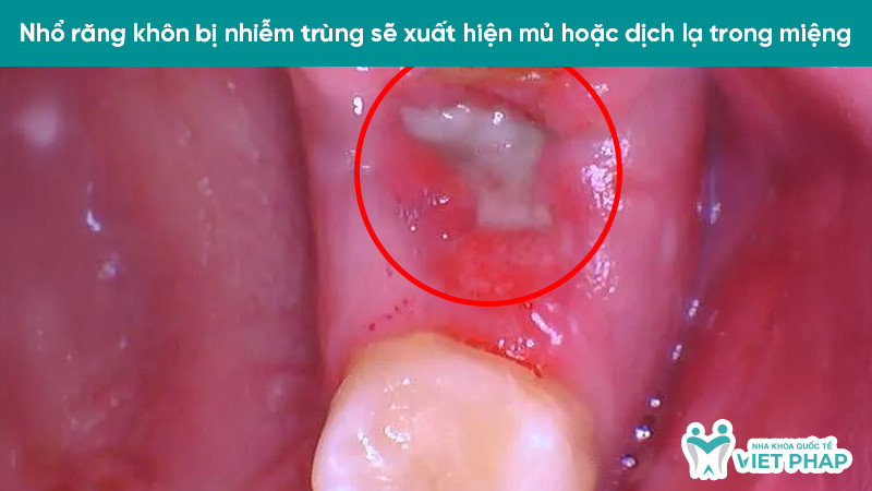 Mủ trắng hoặc dịch vàng xuất hiện tại ổ răng khôn bị nhiễm trùng