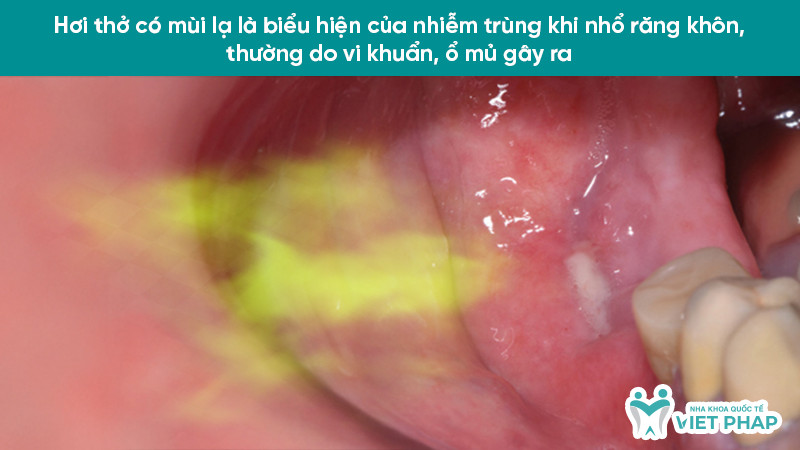 Hơi thở nặng mùi hôi tanh do vi khuẩn gây nhiễm trùng ổ răng khôn