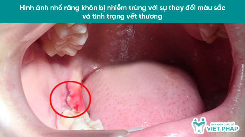 Vết thương sẫm màu, nướu sưng phù và rỉ mủ do viêm nhiễm
