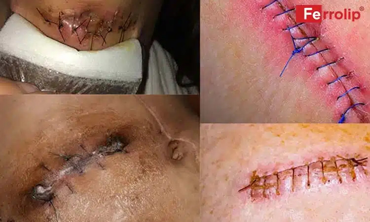 Vết khâu tầng sinh môn bị lồi, tạo thành sẹo gồ ghề