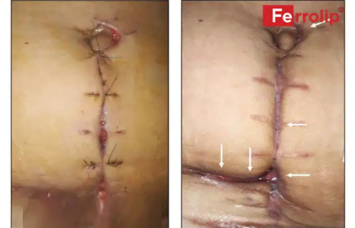 Vết khâu tầng sinh môn có dấu hiệu rách hoặc hở