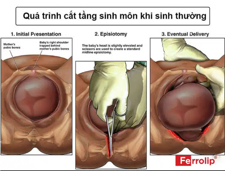 Vết khâu tầng sinh môn đang trong giai đoạn phục hồi