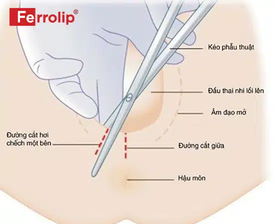 Vết khâu tầng sinh môn đã lành, không còn dấu hiệu sưng tấy hay đỏ