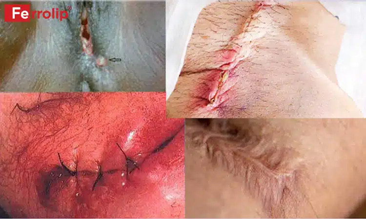 Sẹo lồi rõ rệt tại vị trí vết khâu tầng sinh môn