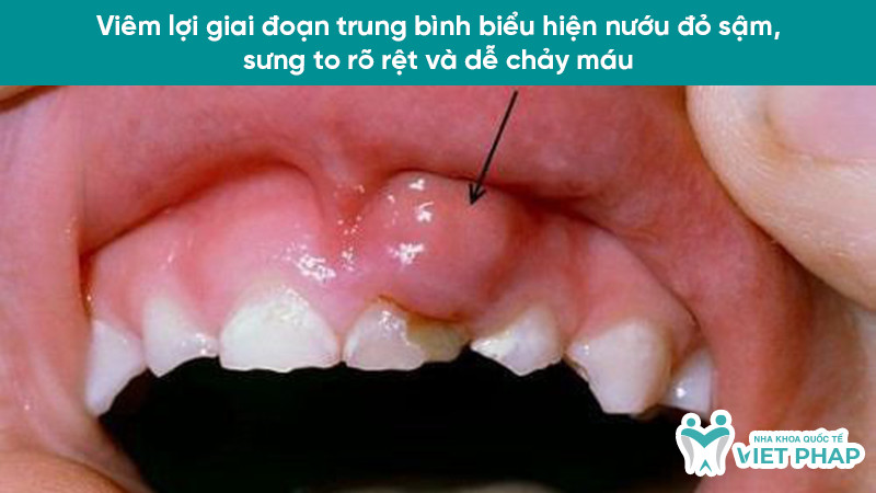 Viêm lợi giai đoạn trung bình biểu hiện nướu đỏ sẫm, sưng to rõ rệt và dễ chảy máu