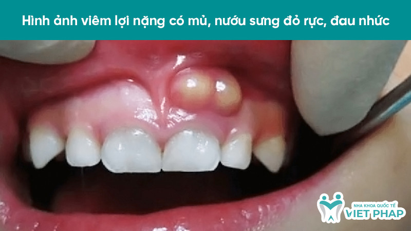 Hình ảnh viêm lợi nặng có mủ, nướu sưng đỏ rực, đau nhức