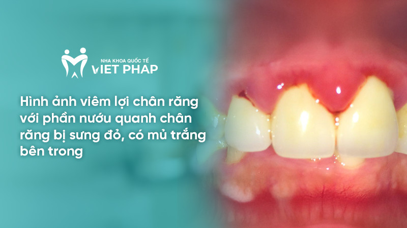 Hình ảnh viêm lợi chân răng với phần nướu quanh chân răng bị sưng đỏ, có mủ trắng bên trong