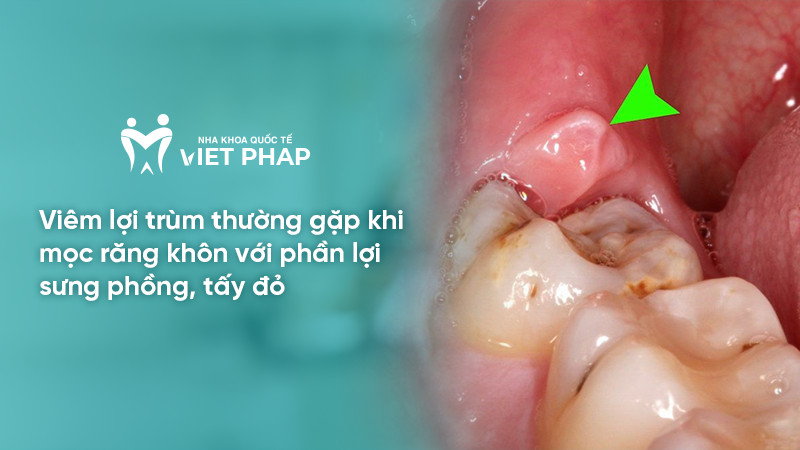 Viêm lợi trùm thường gặp khi mọc răng khôn với phần lợi sưng phồng, tấy đỏ