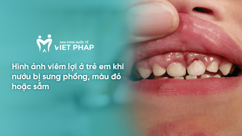 Hình ảnh viêm lợi ở trẻ em khi nướu bị sưng phồng, màu đỏ hoặc sẫm