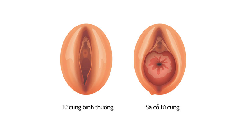 Phá»¥ ná»¯ sau sinh, lÃ m viá»‡c náº·ng vÃ  bÃ©o phÃ¬ cÃ³ nguy cÆ¡ sa tá»­ cung cao hÆ¡n