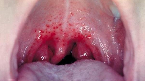 Hình ảnh viêm họng hạt cấp tính