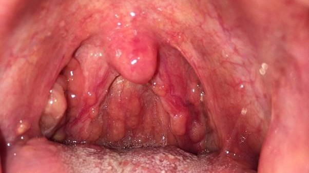 Hình ảnh viêm họng hạt mãn tính