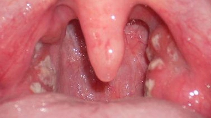 Hình ảnh viêm họng hạt có mủ