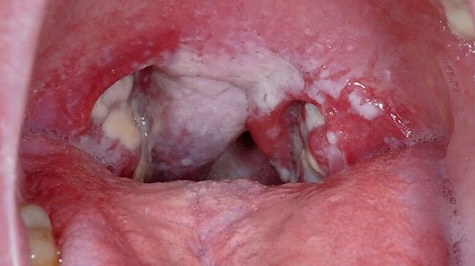 Hình ảnh viêm họng hạt do vi khuẩn
