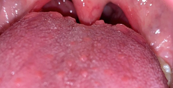 Hình ảnh viêm họng hạt ở lưỡi