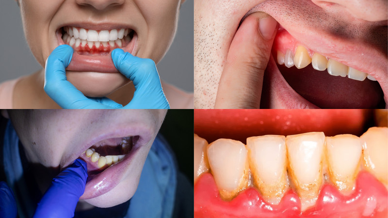 Các biểu hiện phổ biến của viêm nướu răng