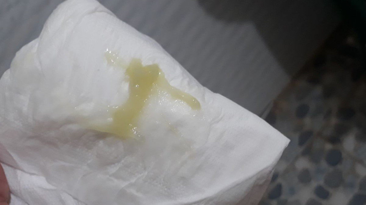 Dịch nút nhầy có thể có màu hồng hoặc nâu nhạt khi bong