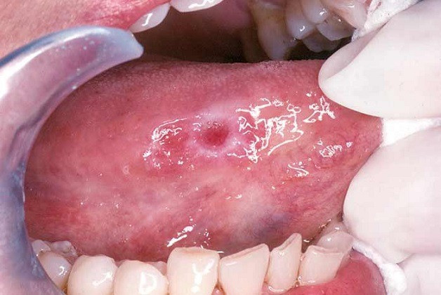 Vết loét trên lưỡi là dấu hiệu cảnh báo ung thư lưỡi