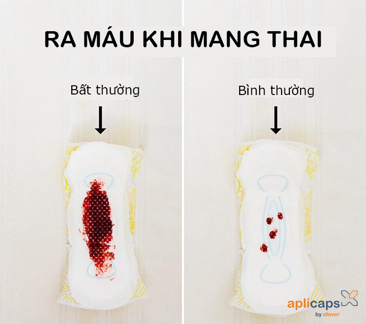 Ra máu khi mang thai bình thường và bất thường