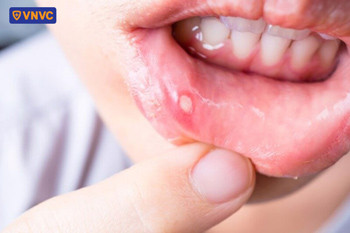 Vết loét nhiệt miệng thường xuất hiện ở môi, lưỡi, lợi hoặc bên trong má