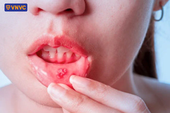 Vết loét nhiệt miệng có màu trắng với viền đỏ bao quanh