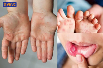 Các vết loét tay chân miệng lan rộng trên lòng bàn tay trẻ