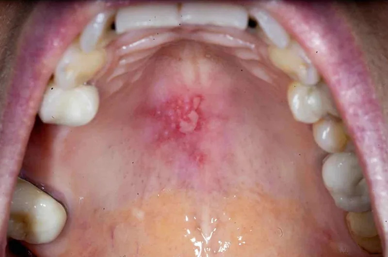 Viêm niêm mạc miệng gây ra các vết loét trong khoang miệng