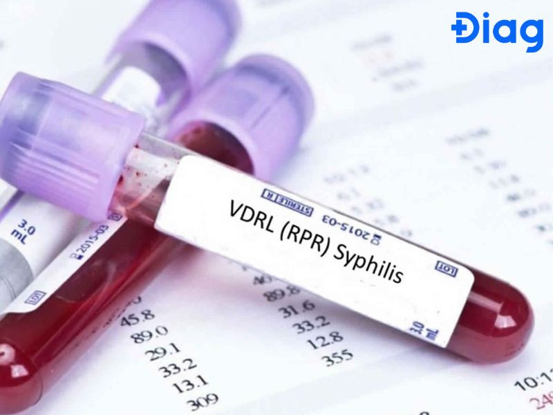 Xét nghiệm giang mai RPR Test