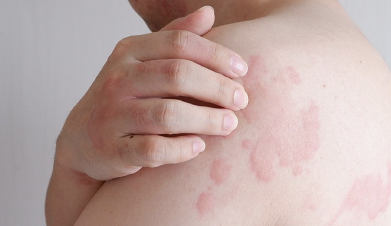 Bị phong ngứa thường làm cho các vùng da trở nên đỏ và ngứa
