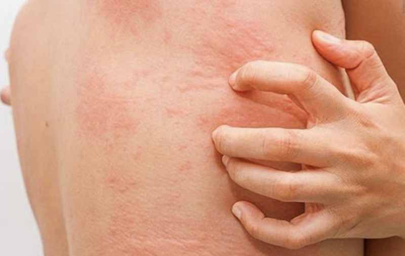 Bị ngứa, đỏ da là triệu chứng phổ biến khi bị phong ngứa