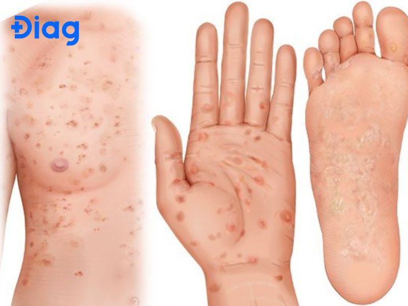 Bệnh giang mai triệu chứng giai đoạn thứ phát