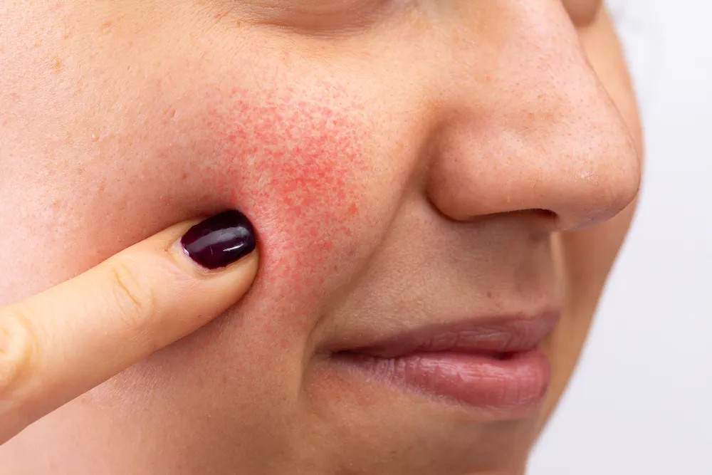 Những biểu hiện có thể xảy ra sau liệu trình Laser Toning