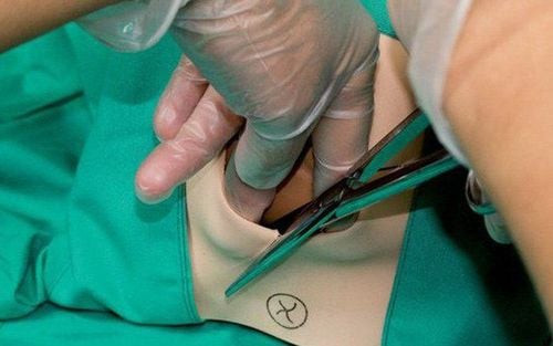 Hình ảnh mô phỏng vị trí vết rạch tầng sinh môn
